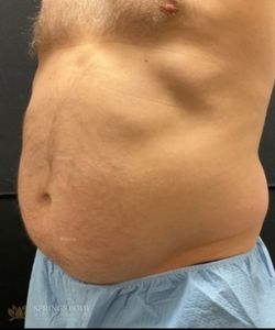 EmSculpt NEO Abs — before photo, Springs Body Sculpting patient