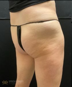EmSculpt NEO Butt — before photo, Springs Body Sculpting patient
