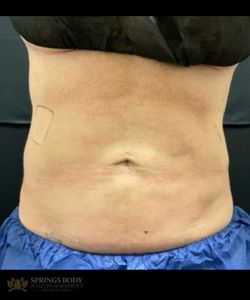 Exion Body Abs — after photo, Springs Body Sculpting patient