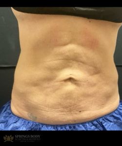 Exion Body Abs — before photo, Springs Body Sculpting patient