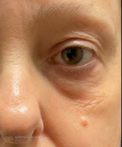 Exion Eyes — after photo, Springs Body Sculpting patient