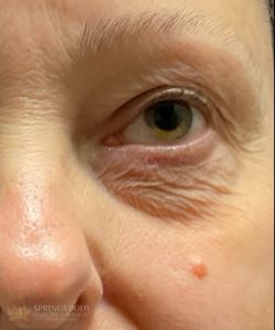 Exion Eyes — before photo, Springs Body Sculpting patient