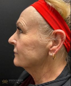 Facetite And Morpheus8 Face — after photo, Springs Body Sculpting patient