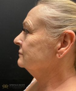 Facetite And Morpheus8 Face — before photo, Springs Body Sculpting patient