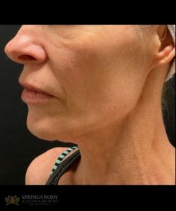 FaceTite Morpheus8 Face — after photo, Springs Body Sculpting patient
