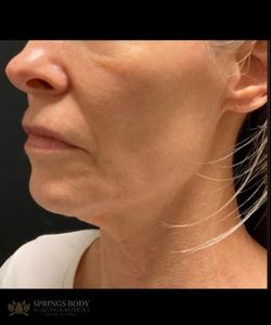 FaceTite Morpheus8 Face — before photo, Springs Body Sculpting patient