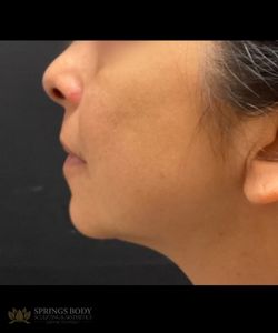 IPL Face — after photo, Springs Body Sculpting patient
