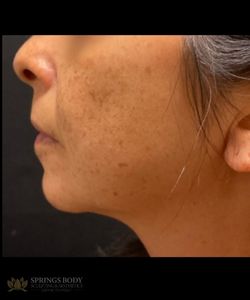 IPL Face — before photo, Springs Body Sculpting patient