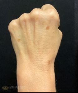 IPL Hand — before photo, Springs Body Sculpting patient