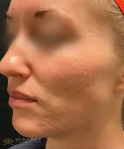Morpheus8 Acne Scarring — after photo, Springs Body Sculpting patient