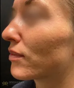 Morpheus8 Acne Scarring — before photo, Springs Body Sculpting patient