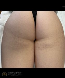 Morpheus8 Stretch Marks Legs — before photo, Springs Body Sculpting patient