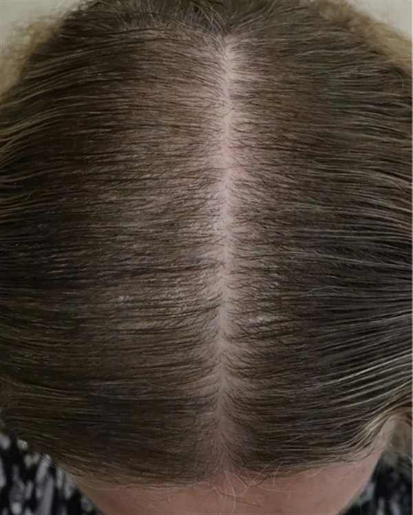 Scalp hair part after 4 TED hair restoration treatments - improved density