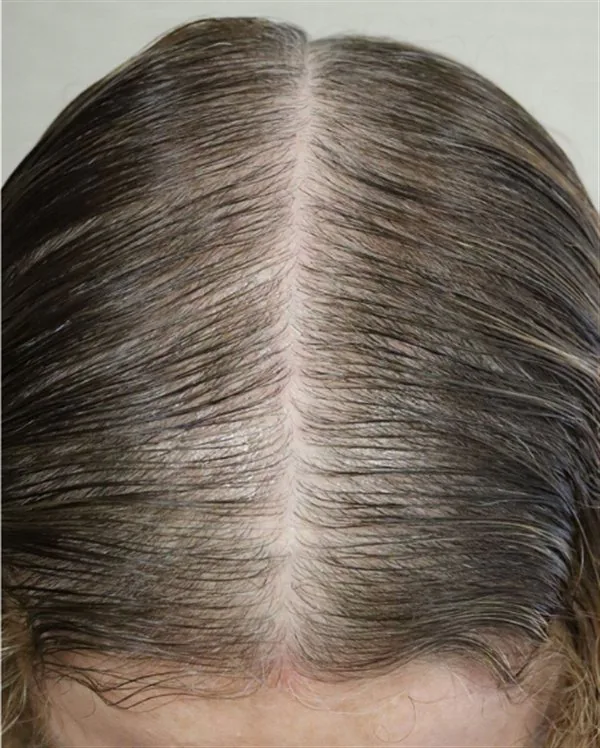 Scalp hair part before TED hair restoration treatment