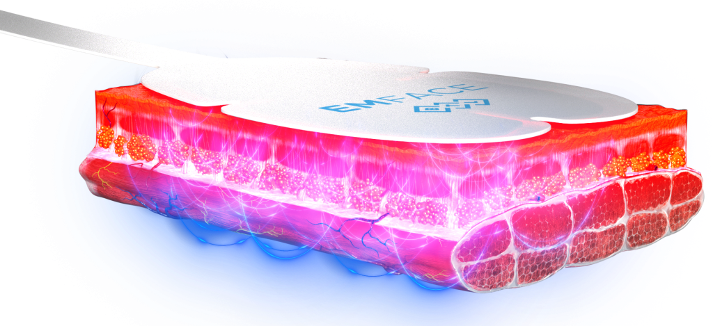 EmFace applicator cross-section showing RF heating the skin and HIFES reaching the muscle layer