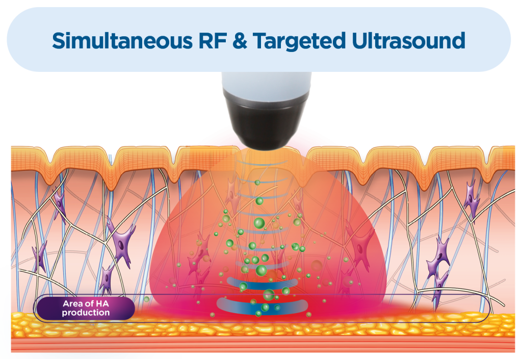 How Exion Face works: simultaneous RF and targeted ultrasound reaching the deep tissue layer to stimulate hyaluronic acid, collagen, and elastin production