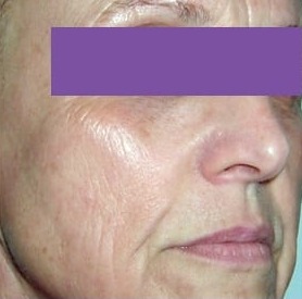 Face after Pixel CO2 Laser resurfacing