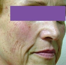 Face before Pixel CO2 Laser resurfacing