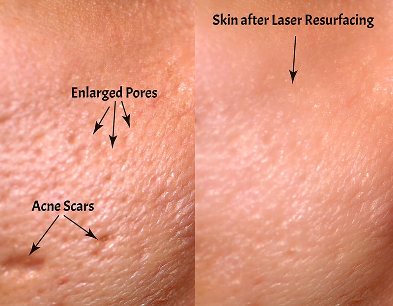 Illustration comparing skin with enlarged pores and acne scars before Pixel CO2 Laser resurfacing to smoother, refined skin after treatment