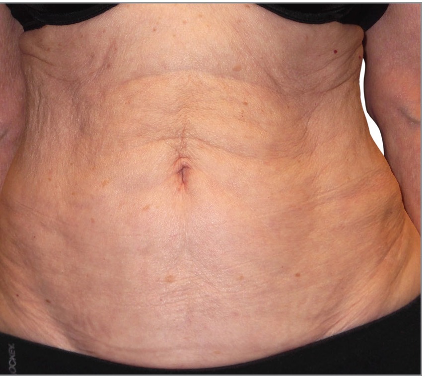 Abdomen after 10 Venus Legacy treatments