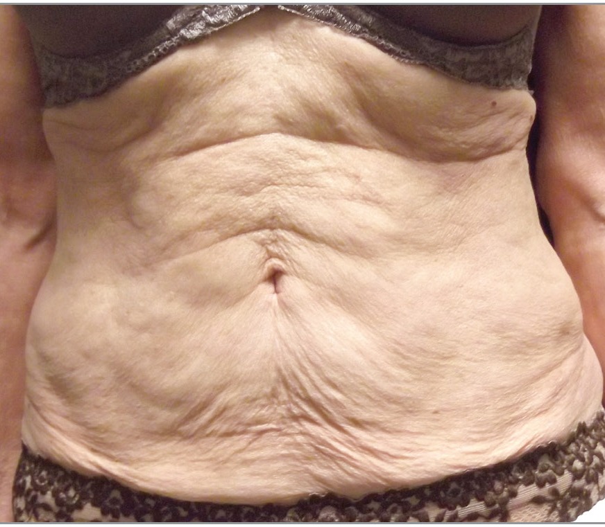 Abdomen before Venus Legacy treatment