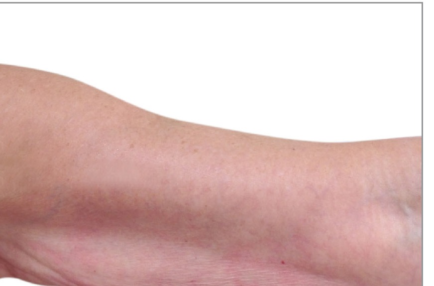 Arm after 5 Venus Legacy treatments