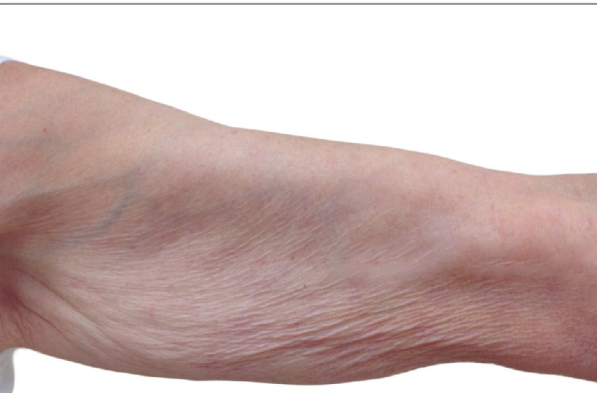 Arm before Venus Legacy treatment