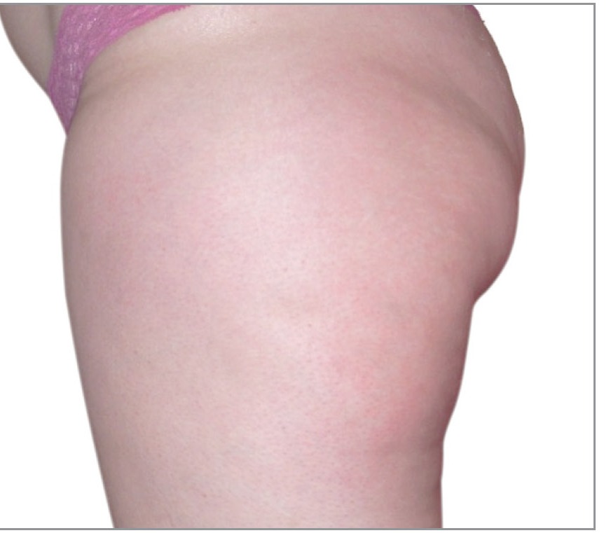 Thigh after 8 Venus Legacy treatments