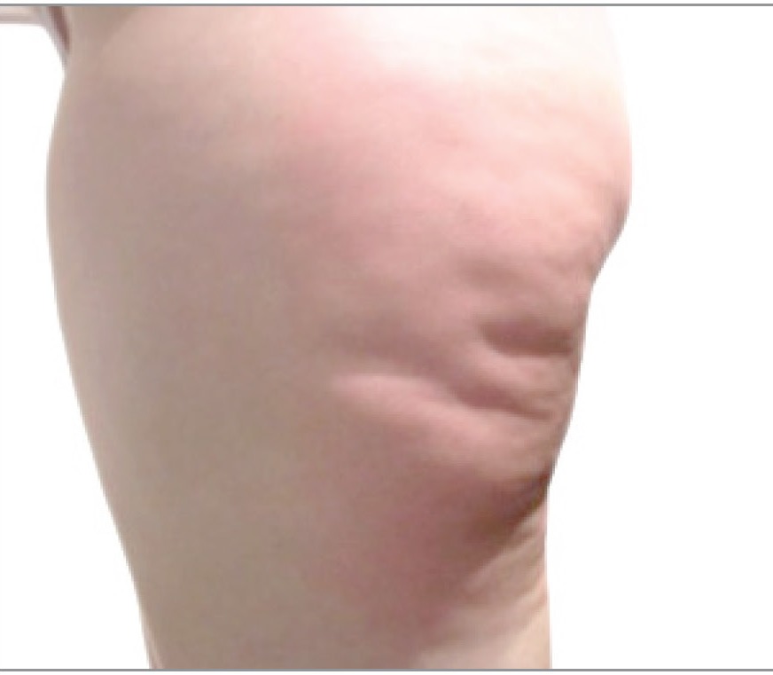 Thigh before Venus Legacy treatment