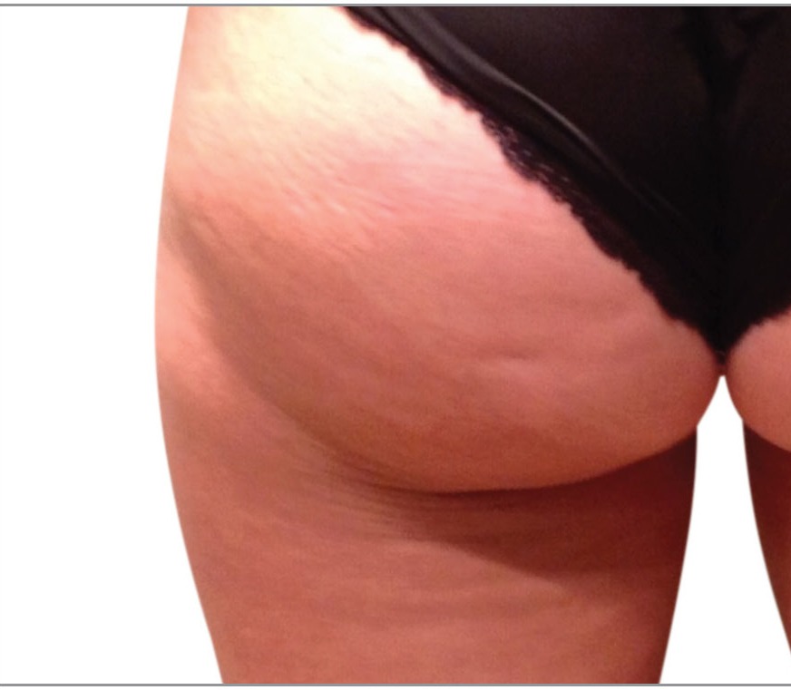 Buttocks before Venus Legacy treatment