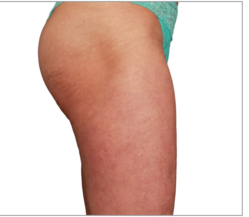 Thigh after 8 Venus Legacy treatments