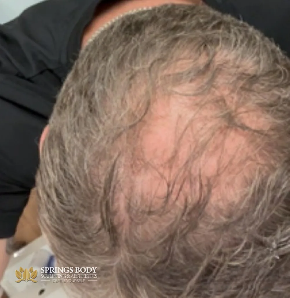 scalp before TED (3 treatments) treatment at Springs Body Sculpting