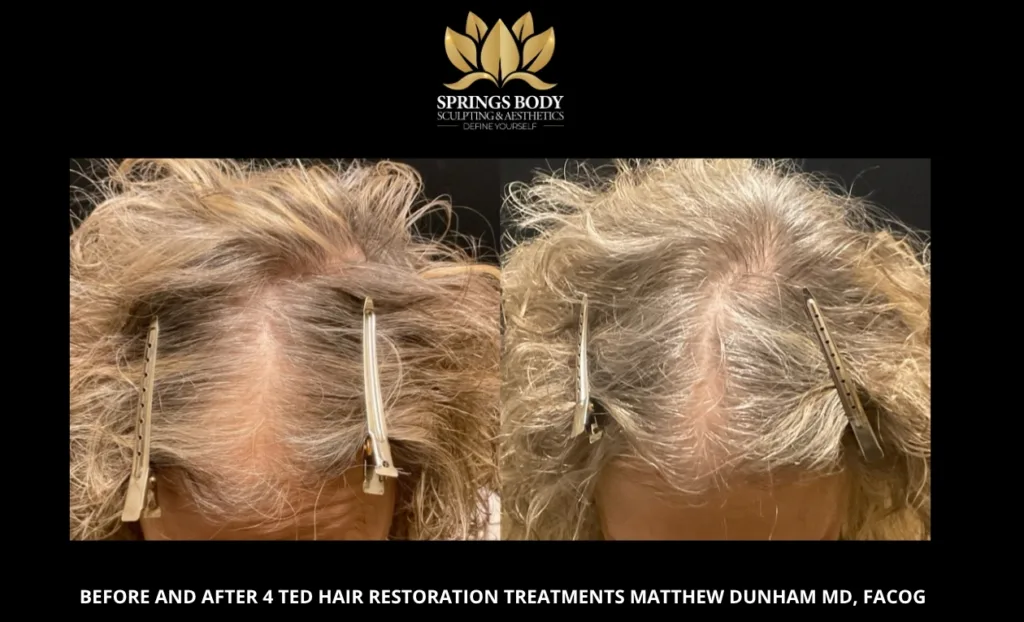 Before and after TED (4 treatments) (scalp) by Matthew Dunham, MD, FACOG at Springs Body Sculpting