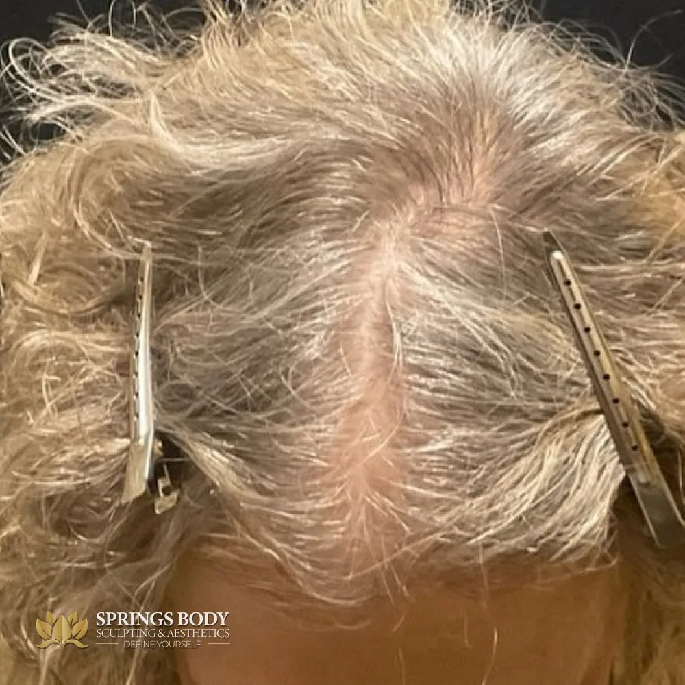 scalp after TED (4 treatments) at Springs Body Sculpting